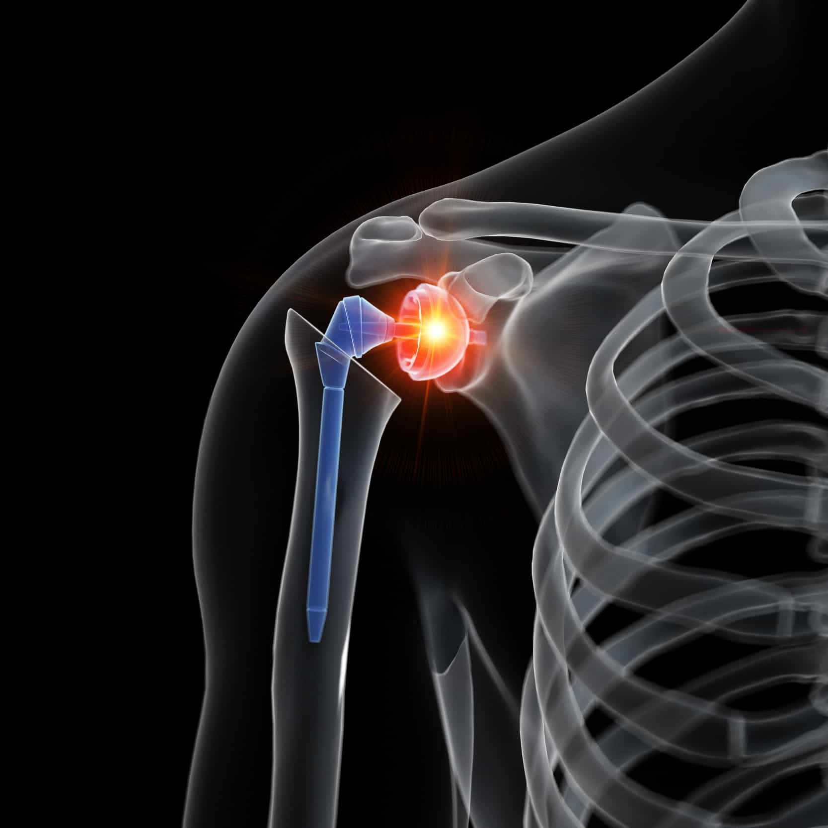 Shoulder Surgery