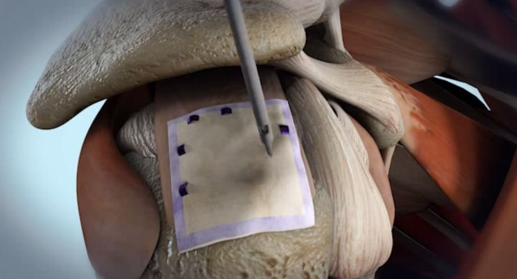 Collagen Implants